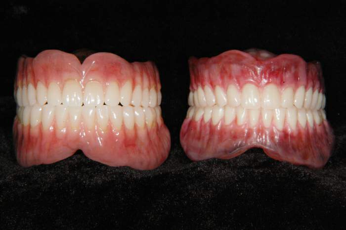 Enceramento STG e Acrilização Caracterizada