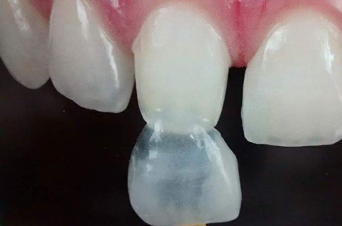 Fragmento e lente de contato cerâmico (Novo)