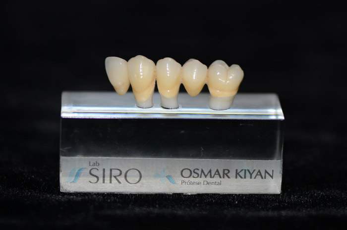 Prótese Fixa Metal-Free (Convencional e CAD CAM)