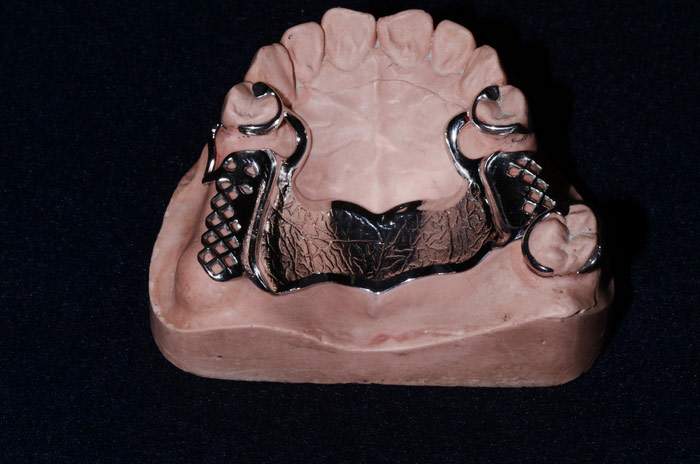 Prótese Removível e Prótese Total